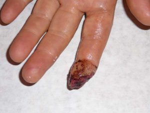 Renee's Finger 1