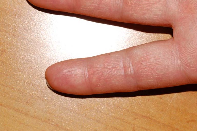 Can You Regrow a Finger? (GRAPHIC) The Grow Network The Grow Network